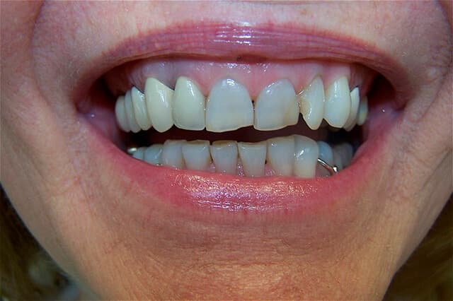 Magnolia Dental - Porcelain Crowns After