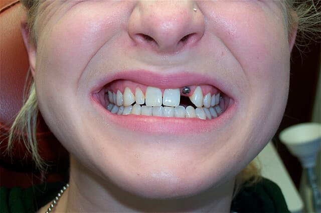 Magnolia Dental - Porcelain Veneer and Implant Combination Before